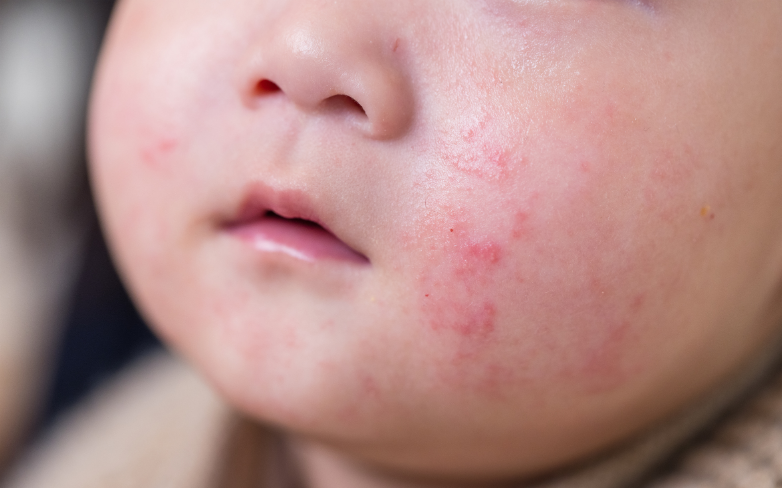 eczéma enfant