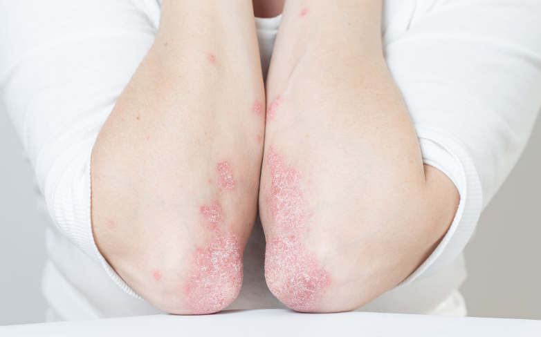 psoriasis
