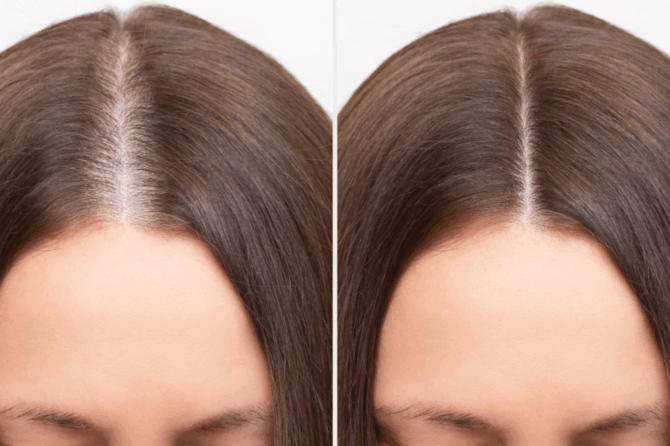 What are the modern solutions for hair loss?